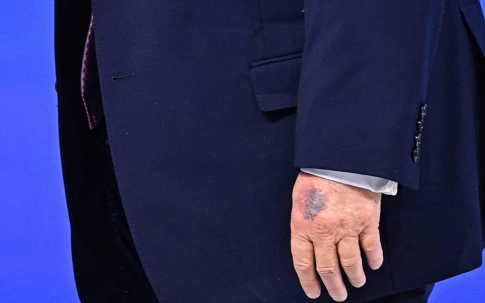 Cover Image for Trump says bruise on his left hand came after hitting a table